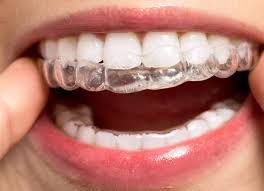 blanqueamiento dental en villa carlos paz